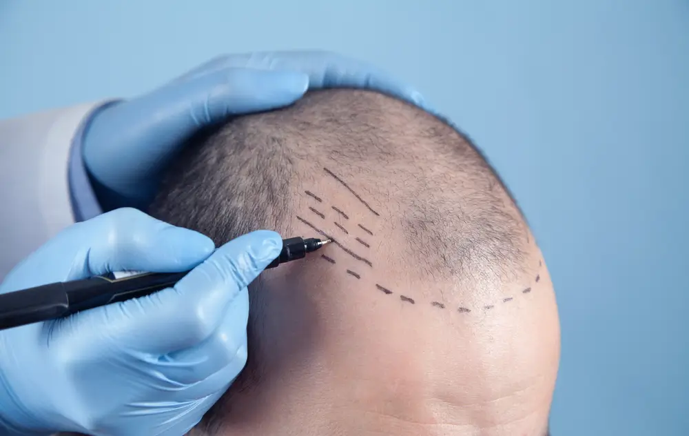 A professional medical team performing a hair transplant procedure in a modern clinic in Turkey. The skilled surgeons are meticulously implanting hair grafts to restore natural hair growth. State-of-the-art equipment and a sterile environment ensure a successful and comfortable experience for the patient.